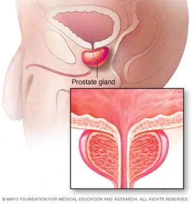Se poate vindeca complet adenomul de prostată?