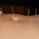 Acupunctura